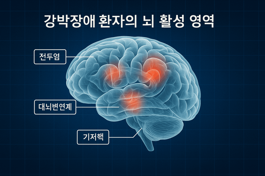 강박장애 환자의 뇌 활성 부위를 보여주는 일러스트