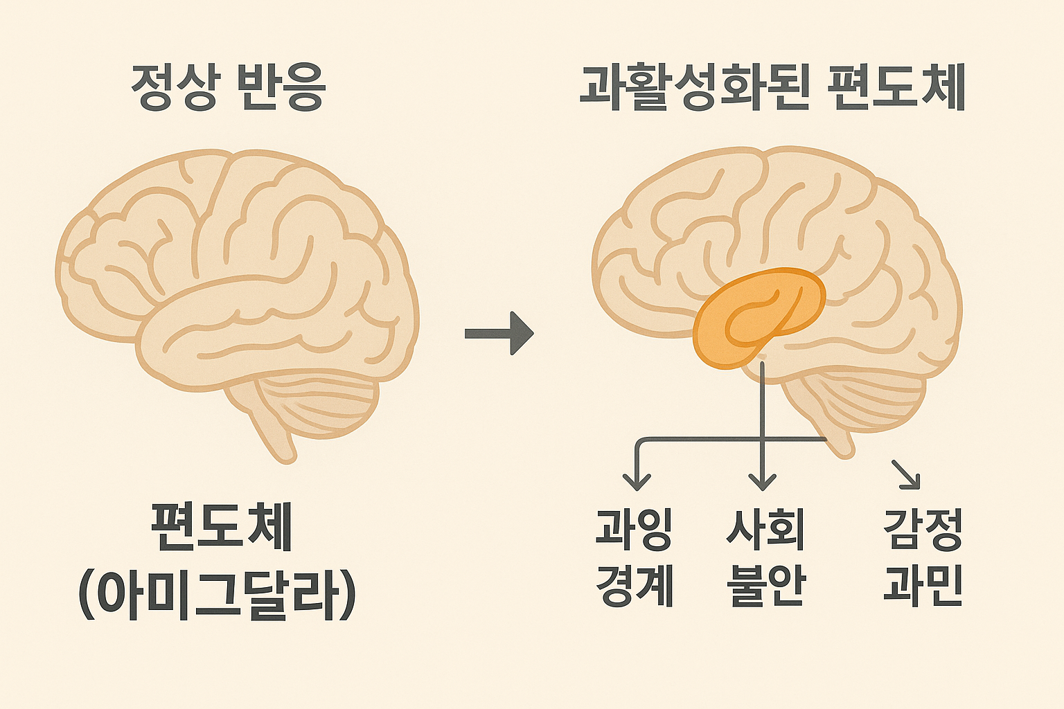 편도체 과활성 반응 인포그래픽